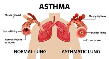 diagrama de asma bronquial con pulmón normal y pulmón asmático vector