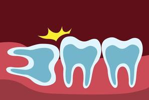 muela del juicio empujando los dientes adyacentes, problema de muelas del juicio. fila de dientes y encía en vector de ilustración plana de dibujos animados de rayos x