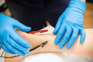 Electro-acupuncture dry with needle connecting machine photo