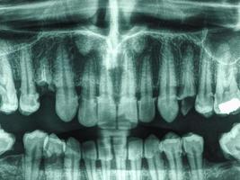 Human teeth xray