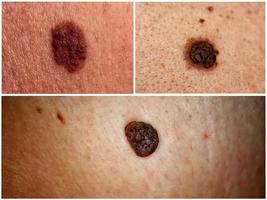 Photo Collage of different moles on human skin.