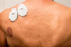 Patient that had cupping therapy done on his upper back and using a TENS Unit for pain relief photo