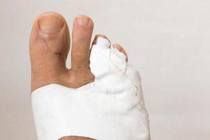 Close up of a Persons Bandaged up Broken Two Little Toes