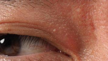 Wart on face. Macro shot of wart near eye. Papilloma on skin. photo