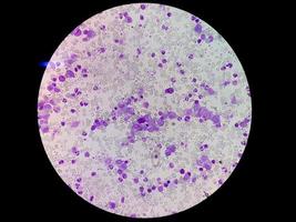 Eessential thrombocytosis blood smear showing abnormal high volume of platelet and White Blood Cell analyze by microscope. Essential thrombocythemia or thrombocytopenia. Microscopic view of slide.