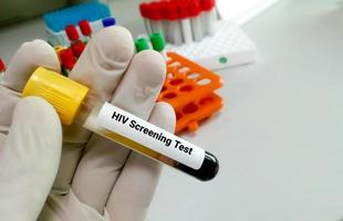 tubo de extracción de sangre de muestra con etiqueta de prueba de vih. prueba de detección de la infección por vih foto