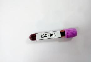 Blood sample for CBC test. Complete blood count