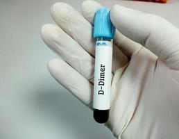 Blood sample for D-Dimer test. Coagulation test photo