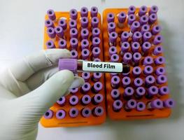Blood sample in lavender tube for Blood Film testing in hematology laboratory. Close up. Medical testing concept. photo
