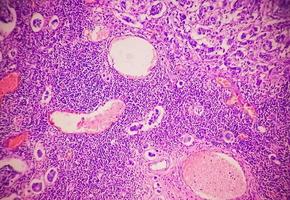 Low power photomicrograph of a breast core biopsy showing an invasive ductal carcinoma grade-II,  most common form of breast cancer. Lymphovascular invasion -  Present photo