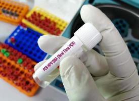 Scientist holding sample container with Cervical Fluid sample for PCR HPV DNA test, Human papilloma virus, cervical cancer. A medical testing concept in the laboratory photo
