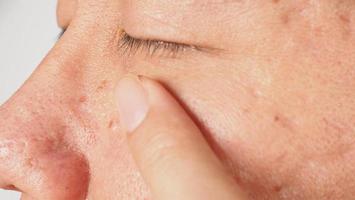 Wart on face. Macro shot of wart near eye. Papilloma on skin. photo