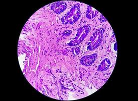 Photomicrograph of a colon biopsy obtained during colonoscopy showing Proctitis photo