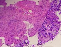 microfotografía de una biopsia de colon obtenida durante una colonoscopia que muestra proctitis