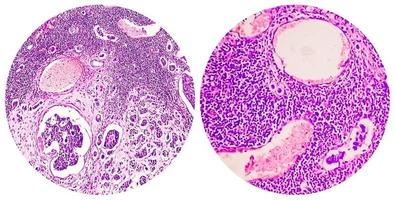 College of two photomicrograph showing Invasive ductal carcinoma photo