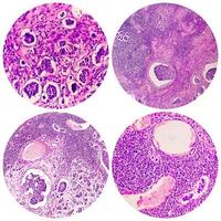 College of four photomicrograph showing Invasive ductal carcinoma photo