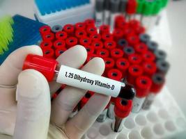 Blood sample for 25 Dehyroxy Vitamin-D test with laboratory background. Close up. Osteoporosis. Vitamin d2