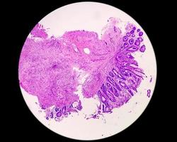 microfotografía de una biopsia de colon obtenida durante una colonoscopia que muestra proctitis foto