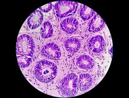 microfotografía de cáncer de recto. vista de portaobjetos microscópico. ibd. SII. de cerca. foto