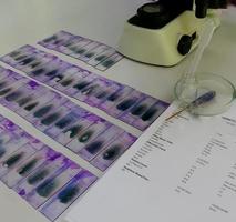 Se aíslan los portaobjetos de vidriera de frotis de sangre periférica con tinción violeta de Leishman Giemsa en el departamento de hematología, que está listo para el examen microscópico. informe de rabotarory y microscopio. foto