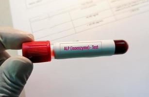 Vista cercana de la mano del científico mantenga la muestra de sangre para alp - prueba de isoenzimas foto