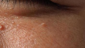 Wart on face. Macro shot of wart near eye. Papilloma on skin. photo