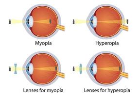 hipermetropía y miopía corregidas por lente. concepto de defecto ocular. corrección de diversos trastornos de la visión ocular mediante lentes. vector