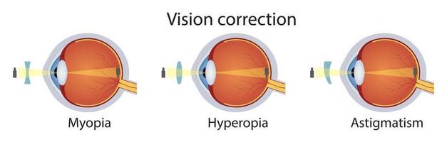 Correction of various eye vision disorders by lens. Hyperopia, myopia, astigmatism. Vector illustration