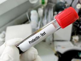 Blood sample for Prolactin hormone test.