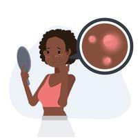 concepto de acné espinillas. problemas de la piel. mujer afroamericana está preocupada porque su cara tiene acné. Ilustración de personaje de dibujos animados de vector plano.