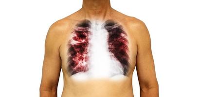 Pulmonary tuberculosis . Human chest with x-ray show cavity at right upper lung and interstitial infiltrate both lung due to infection . Isolated background photo