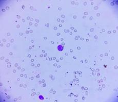 microfotografía de anemia leucoeritroblástica. 100 veces foto