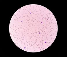 Photomicrograph of Leuco-erythroblastic anemia. 40X photo