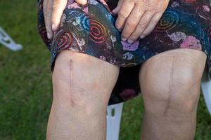 Asian senior lady old woman patient show her scars surgical total knee joint replacement. photo