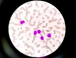 Microscopic view of thrombocytopenia-low platelet counts. hematology, 100X photo