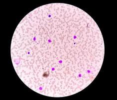 Microscopic view of Hematology slide . close view. photo