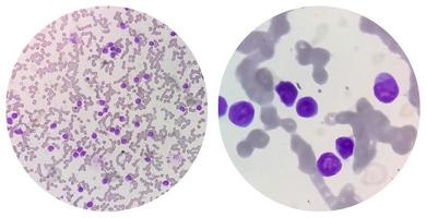 Collage image of two micrograph show Auer rods seen in acute myeloid leukemia. Myeloblasts