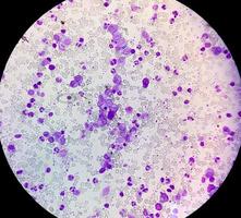 Eessential thrombocytosis blood smear showing abnormal high volume of platelet and White Blood Cell analyze by microscope. Essential thrombocythemia or thrombocytopenia. Microscopic view of slide. photo