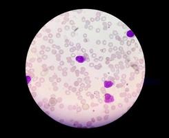 Myeloblasts with Auer rods seen in acute myeloid leukemia.