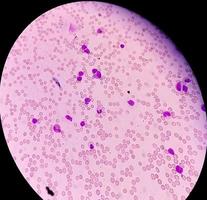 Microscopic view of cold agglutinin disease. autoimmune hemolytic anemia. CAD