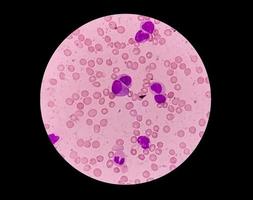 vista microscópica de la leucemia mieloide aguda. leucemia mieloblástica, un cáncer de glóbulos blancos, 40x. aml foto