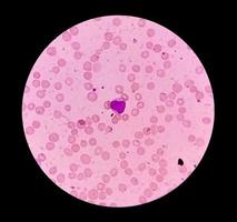 vista microscópica de leucemia mieloide aguda, leucemia mieloblástica, un cáncer de glóbulos blancos. aml foto