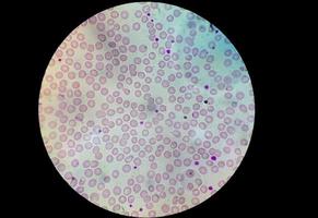 Microscopic view of stained slide of Hematology in laboratory. close up. total blood count. photo