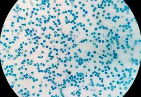 Close microscopic view of abnormal reticulocyte count in hematology department, methylene blue staining photo