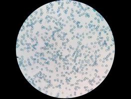 Close microscopic view of abnormal reticulocyte count in hematology department, methylene blue staining photo