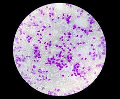 Microscopic view of hematological stained slide. thrombocytopenia photo