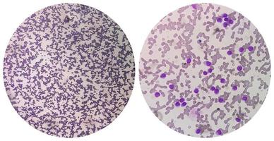 Collage image of two micrograph show Auer rods seen in acute myeloid leukemia. Myeloblasts photo