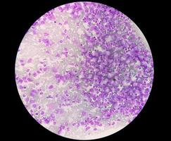 vista microscópica de trombocitopenia con leucocitosis. hematología foto