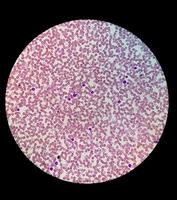 Microscopic view of stained slide of Hematology in laboratory. close up. total blood count. photo