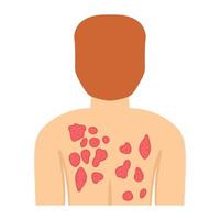 Editable design of body rashes vector